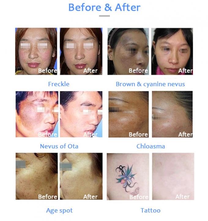 Machine de beauté de traitement de problèmes de peau de retrait de tatouage de laser de picoseconde de Honkon avec moins Pih 1