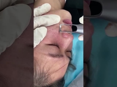 machine de laser de picoseconde de salon de 1064nm 532nm pour le traitement de problème de lésions de pigmentation de peau