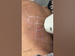 Long pulse 1064nm yag laser beauty machine for black skin